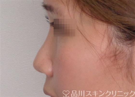 症例NO.50308のBEFORE写真