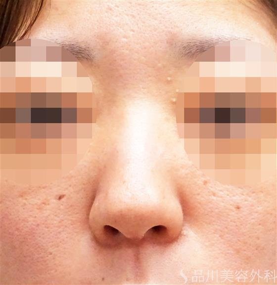 症例NO.48183のBEFORE写真