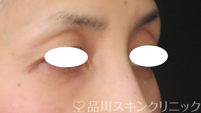 症例NO.63128のBEFORE写真