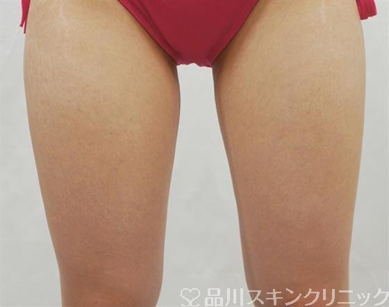 症例NO.41870のBEFORE写真