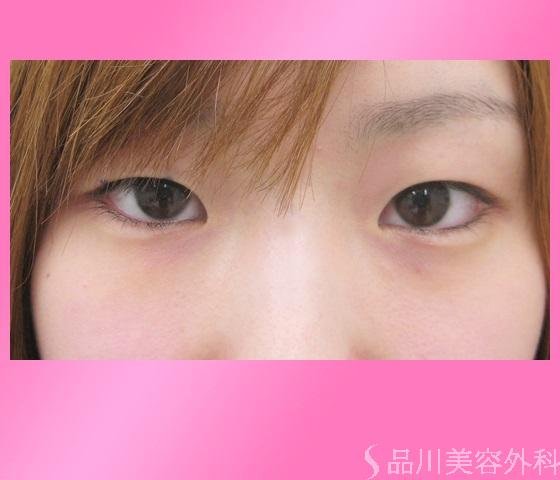 症例NO.12949のBEFORE写真