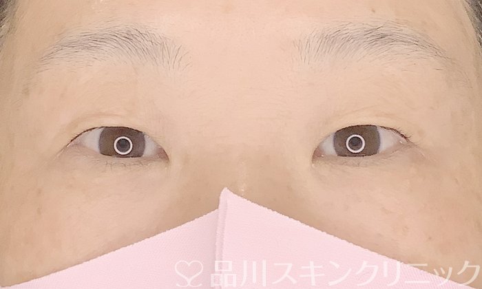 症例NO.67623のBEFORE写真