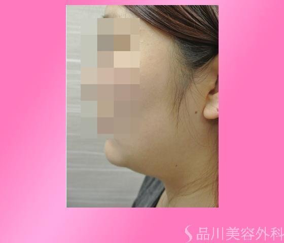 症例NO.14558のBEFORE写真