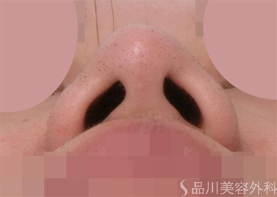 症例NO.28018のBEFORE写真