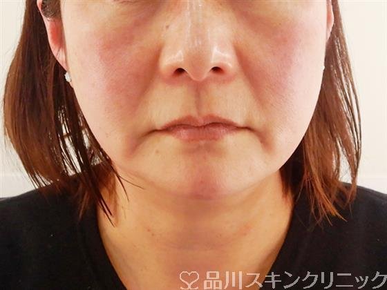 症例NO.58646のBEFORE写真