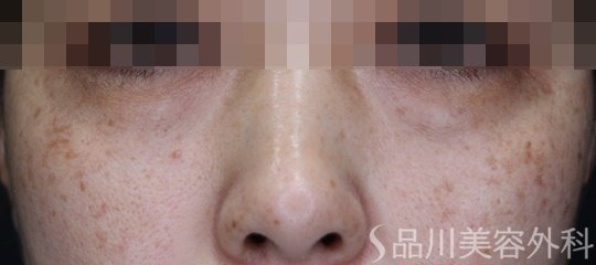 症例NO.66455のBEFORE写真