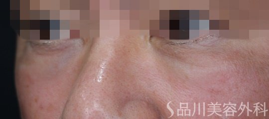 症例NO.67325のBEFORE写真