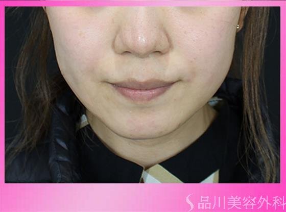 症例NO.49941のBEFORE写真