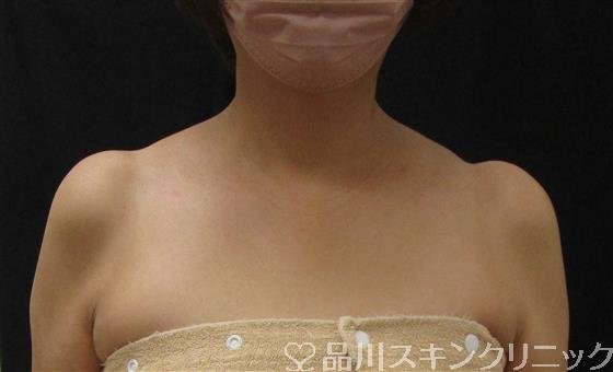 症例NO.61230のBEFORE写真