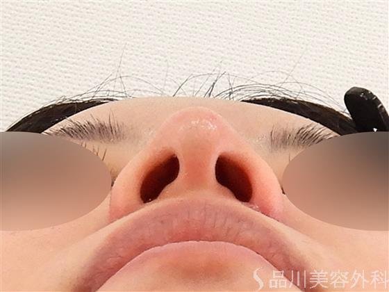 症例NO.61557のAFTER写真