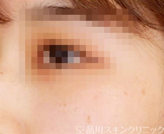 症例NO.53818のBEFORE写真