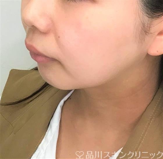 症例NO.57169のBEFORE写真