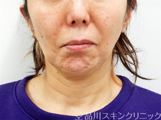 症例NO.53086のBEFORE写真