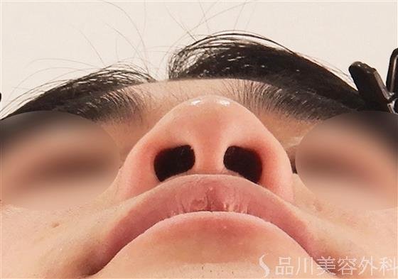 症例NO.58079のBEFORE写真