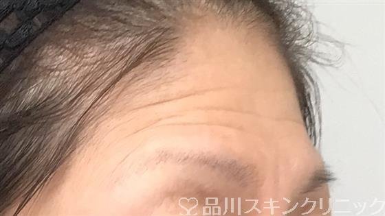 症例NO.60306のBEFORE写真