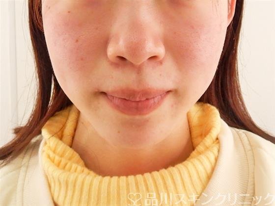 症例NO.58284のBEFORE写真