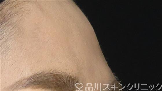 症例NO.61530のBEFORE写真