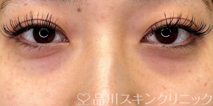 症例NO.66158のBEFORE写真