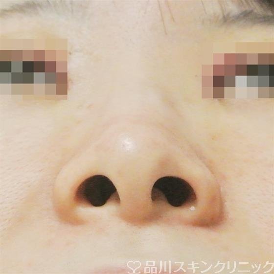 症例NO.33157のBEFORE写真