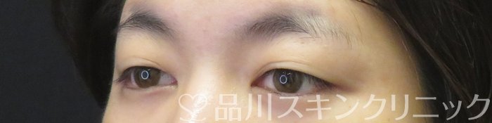 症例NO.62906のBEFORE写真