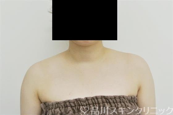 症例NO.29634のBEFORE写真