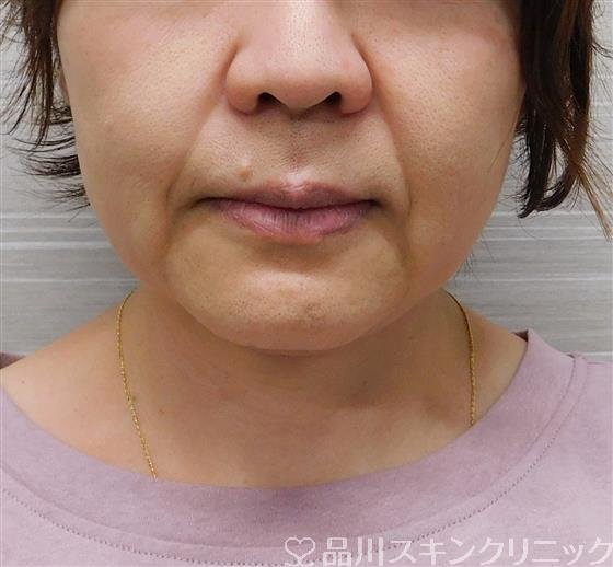 症例NO.48894のBEFORE写真