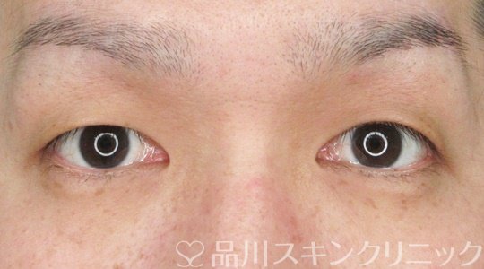 症例NO.66587のBEFORE写真