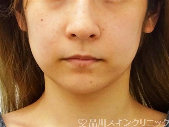 症例NO.51152のBEFORE写真