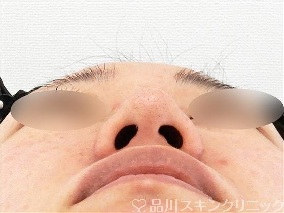 症例NO.56741のBEFORE写真