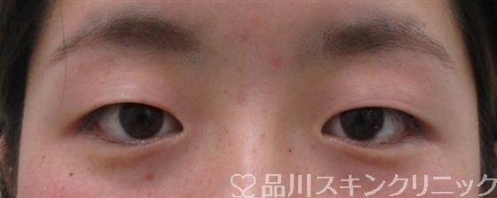 症例NO.53198のBEFORE写真