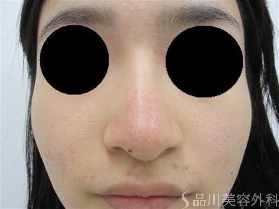 症例NO.2986のBEFORE写真