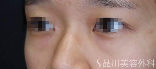 症例NO.64462のBEFORE写真