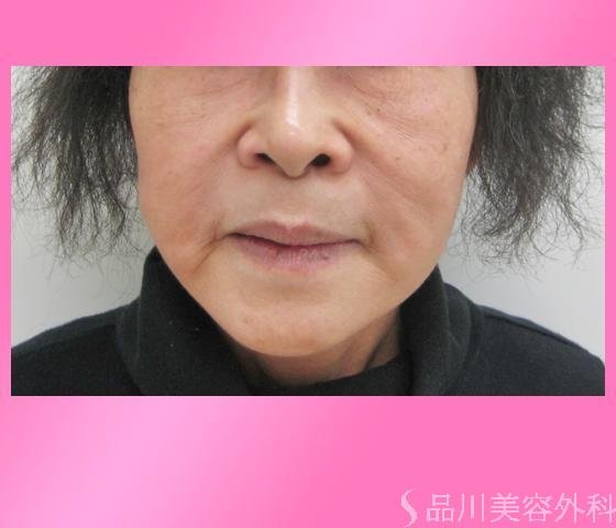 症例NO.2632のBEFORE写真