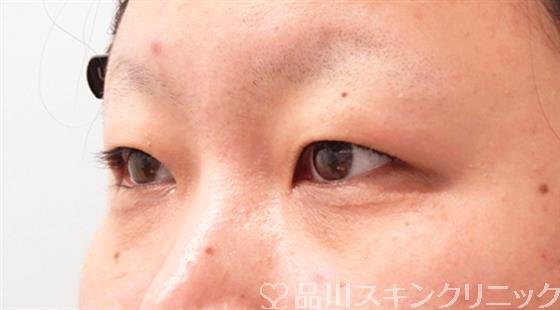 症例NO.54006のBEFORE写真