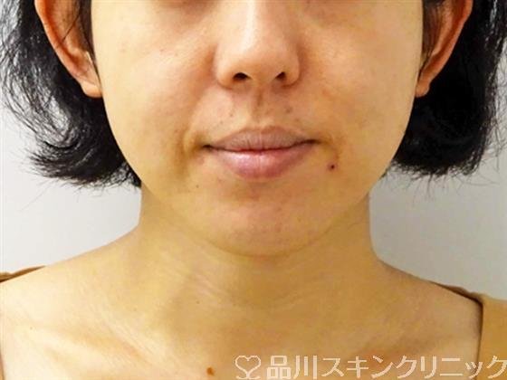 症例NO.49089のBEFORE写真