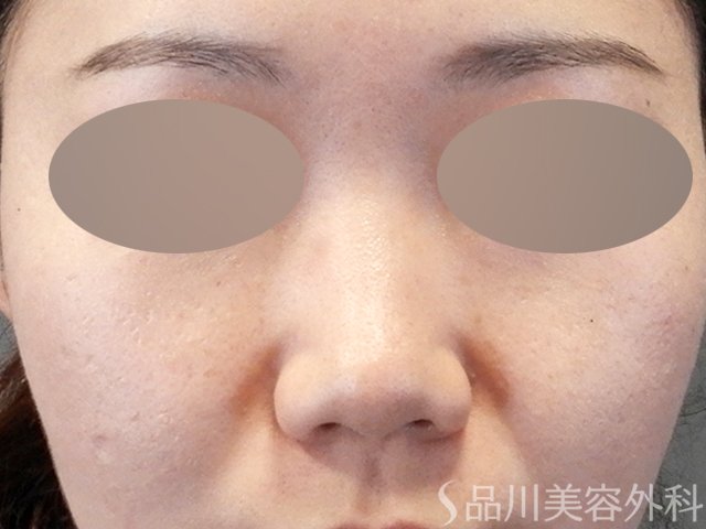 症例NO.64674のBEFORE写真