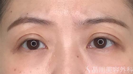 症例NO.59366のBEFORE写真