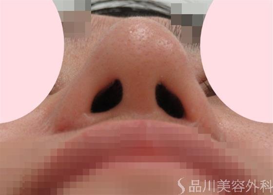 症例NO.28163のAFTER写真