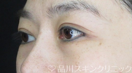 症例NO.68513のBEFORE写真