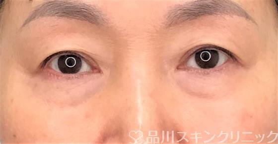 症例NO.56964のBEFORE写真