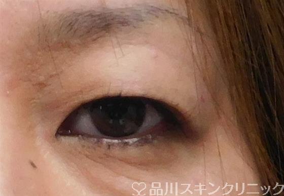 症例NO.51091のBEFORE写真