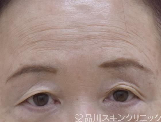 症例NO.59200のBEFORE写真