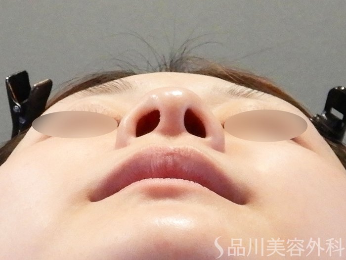 症例NO.68426のBEFORE写真