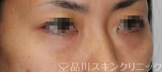 症例NO.64805のBEFORE写真