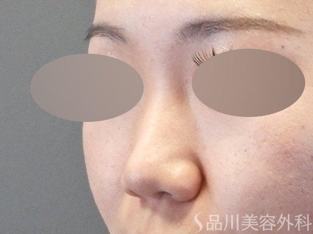 症例NO.65424のBEFORE写真