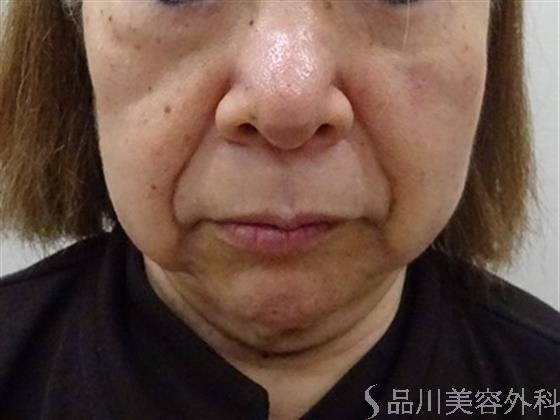 症例NO.40190のBEFORE写真