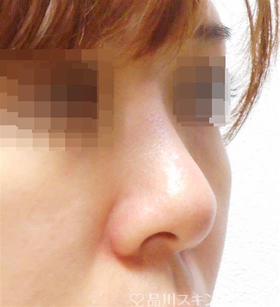 症例NO.46277のBEFORE写真