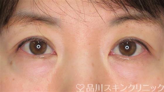 症例NO.49980のBEFORE写真