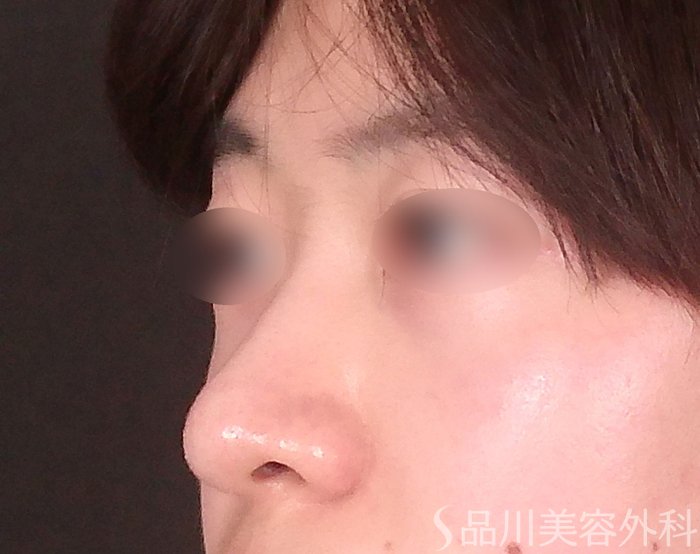 症例NO.69088のBEFORE写真