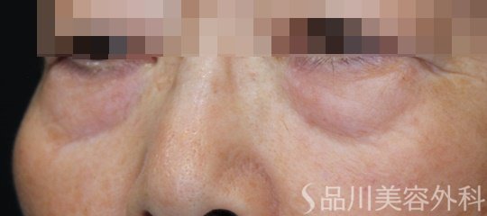 症例NO.68721のBEFORE写真